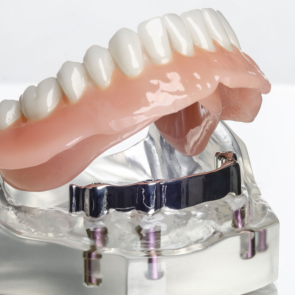 Zahnersatz auf Implantaten